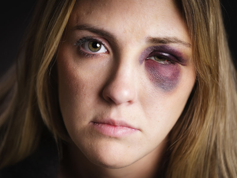 Woman with a Black Eye